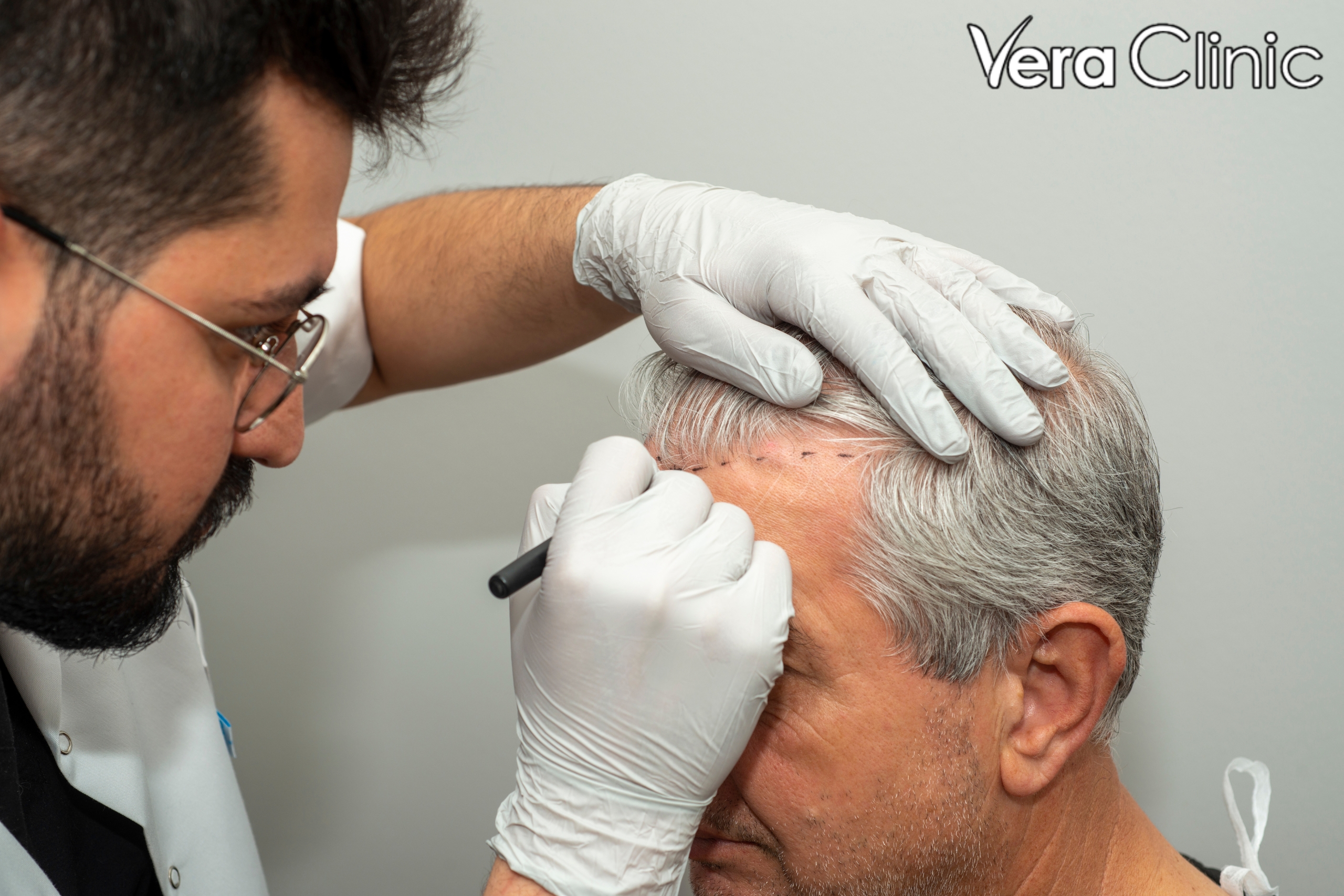 best hair transplant clinic in turkey
